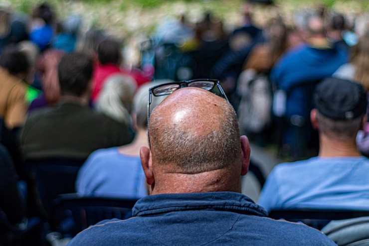 Cosa fare contro la calvizie